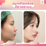 ไขความลับ จมูกทรง Teardrop ทำไมถึงครองใจสาวไทย