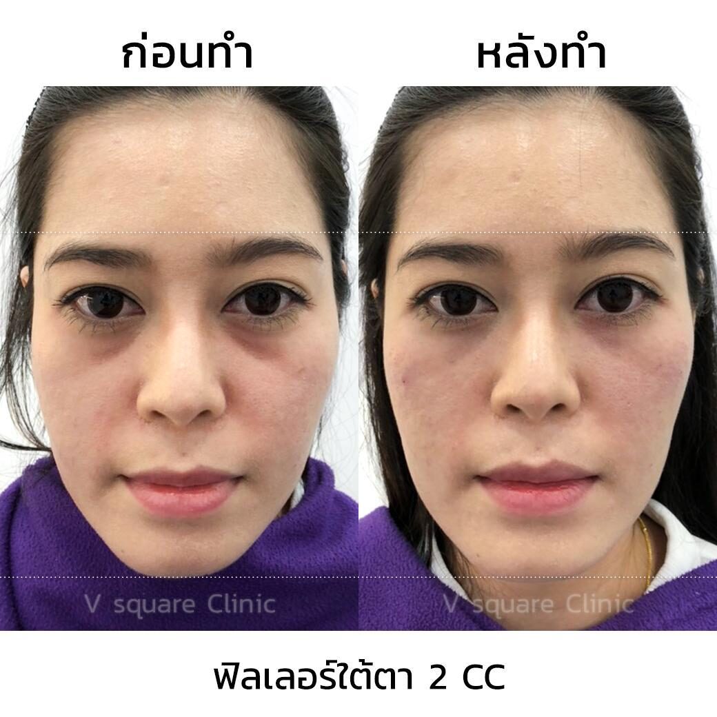 ฟิลเลอร์ใต้ตารีวิว
