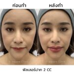 ฉีดฟิลเลอร์ คืออะไร ? เหมาะกับใคร ? รู้ข้อดี-ข้อเสียก่อนฉีดปรับรูปหน้า 