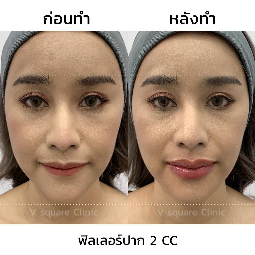 รีวิว ฉีดฟิลเลอร์ รีวิว ฉีดฟิลเลอร์