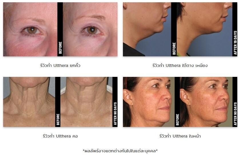Ulthera รีวิว Ulthera รีวิว