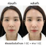 ฉีดฟิลเลอร์ครั้งแรก ควรรู้อะไรบ้าง ? อันตรายไหม ? ฉีดจุดไหน ใช้กี่ CC