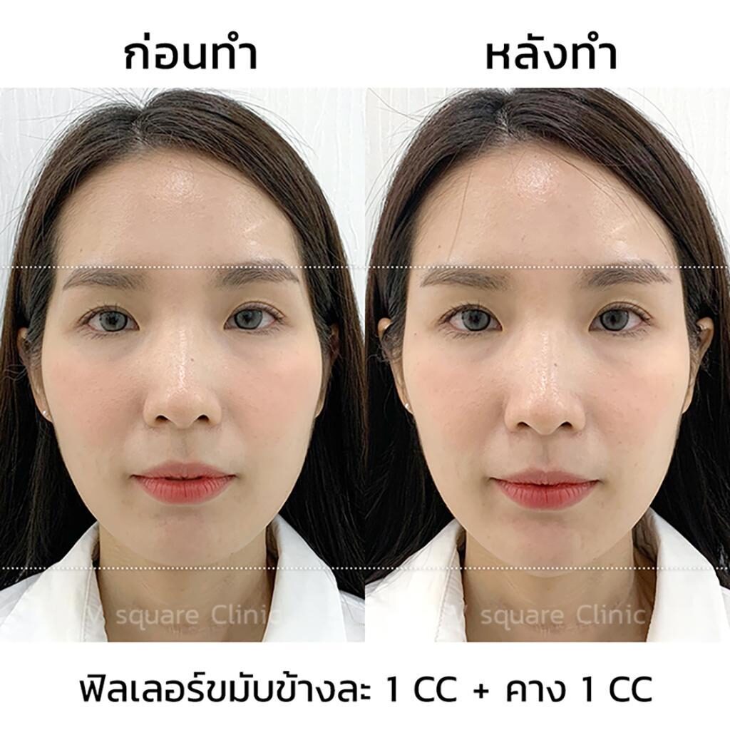รีวิวฉีดฟิลเลอร์