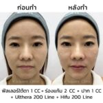 Hifu คืออะไร ช่วยอะไรบ้าง ? เปรียบเทียบ Hifu VS Thermage VS Ulthera ต่างกันอย่างไร ?