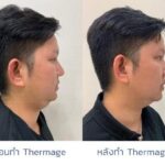Thermage ช่วยเรื่องอะไรบ้าง ? เห็นผลเร็วไหน เหมาะกับใคร ? อยู่ได้นานไหม ?