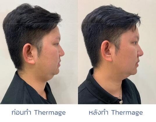 รีวิวการทำ Thermage