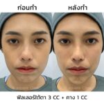 ฉีดฟิลเลอร์ คืออะไร ? เหมาะกับใคร ? รู้ข้อดี-ข้อเสียก่อนฉีดปรับรูปหน้า 