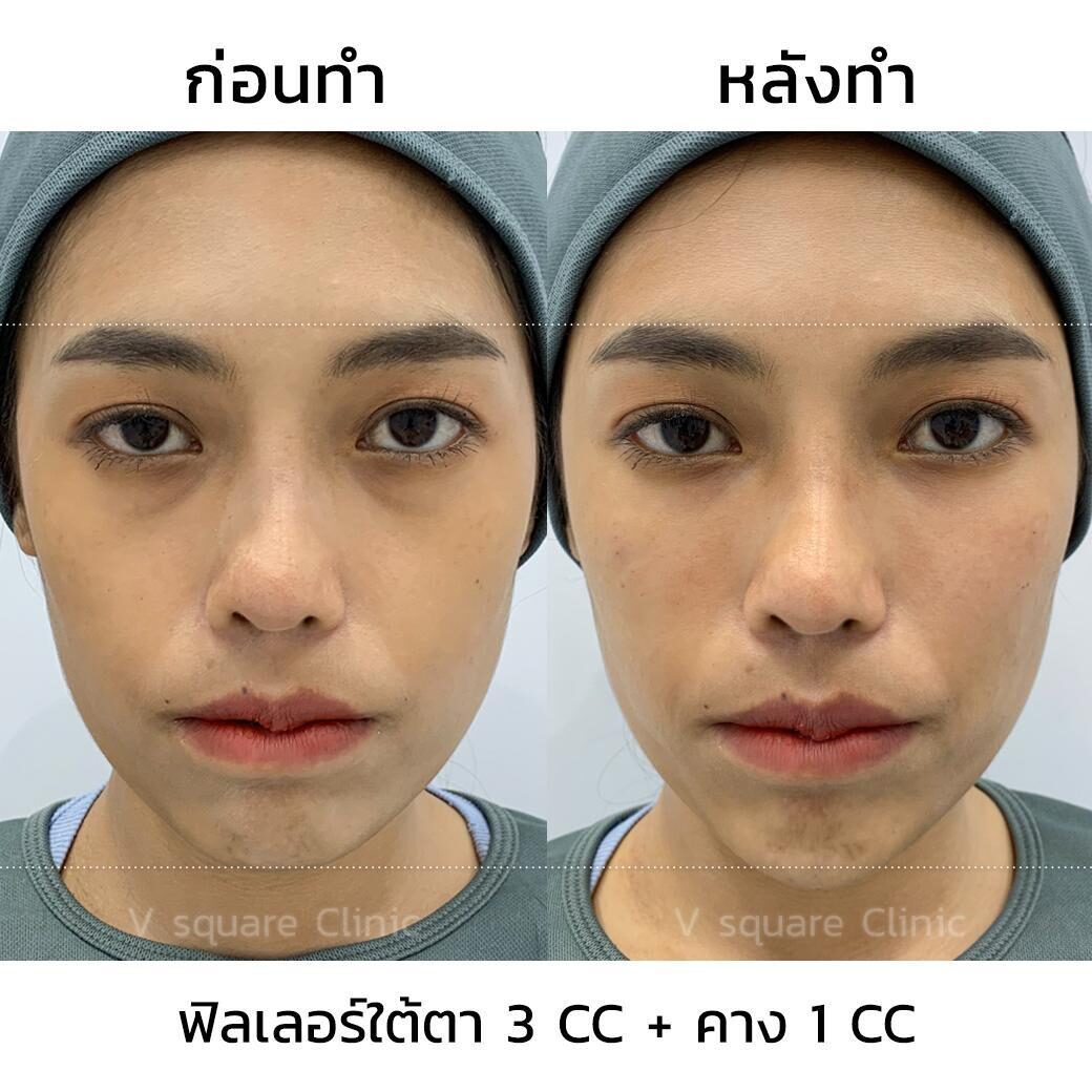 รีวิว ฉีดฟิลเลอร์ รีวิว ฉีดฟิลเลอร์
