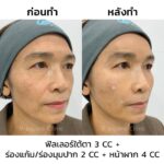 ฉีดฟิลเลอร์ครั้งแรก ควรรู้อะไรบ้าง ? อันตรายไหม ? ฉีดจุดไหน ใช้กี่ CC