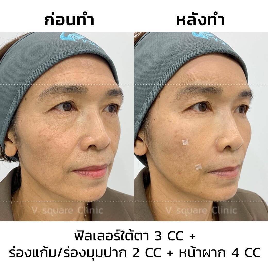รีวิวฉีดฟิลเลอร์