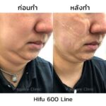 Hifu คืออะไร ช่วยอะไรบ้าง ? เปรียบเทียบ Hifu VS Thermage VS Ulthera ต่างกันอย่างไร ?