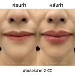 ฉีดฟิลเลอร์ครั้งแรก ควรรู้อะไรบ้าง ? อันตรายไหม ? ฉีดจุดไหน ใช้กี่ CC