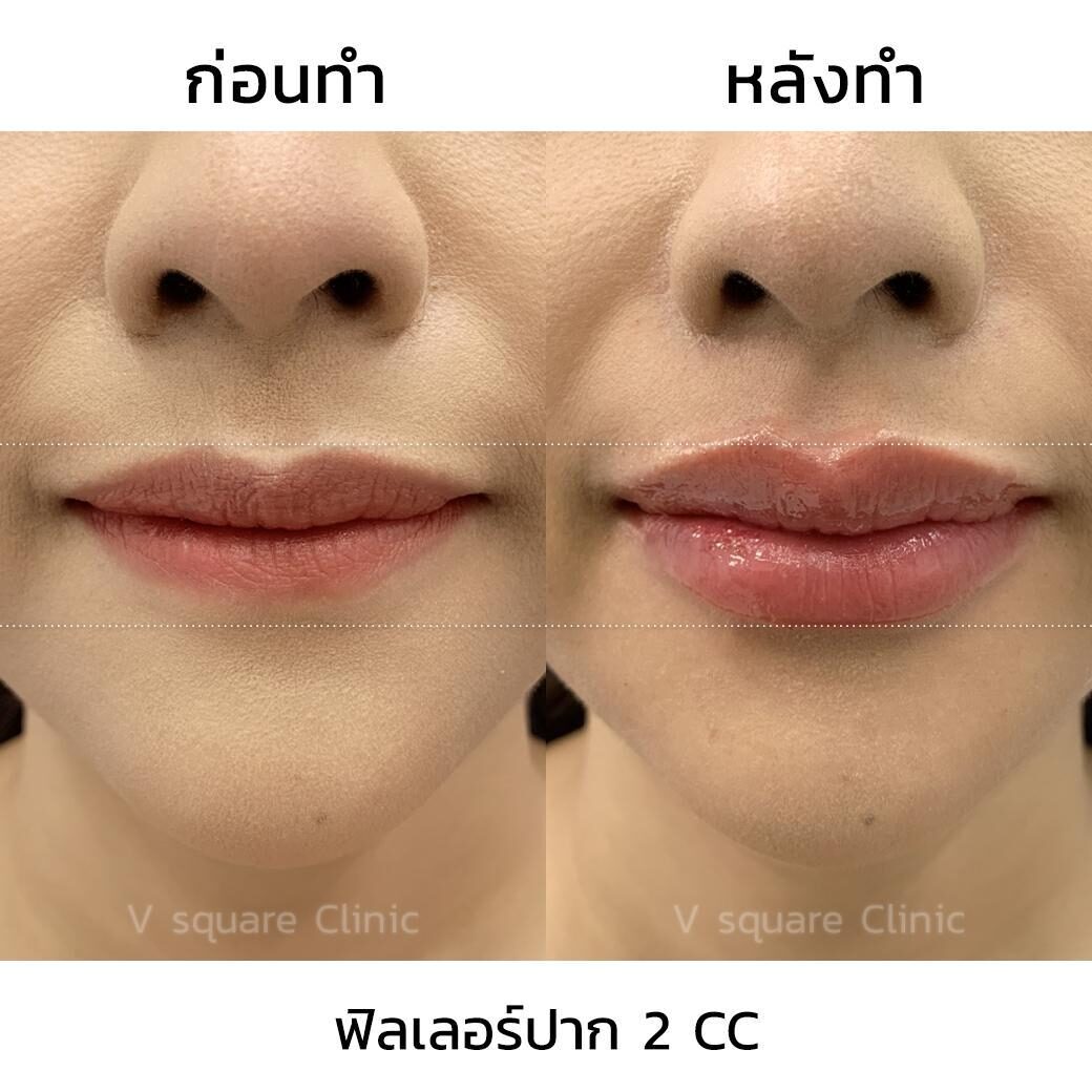 รีวิวฉีดฟิลเลอร์