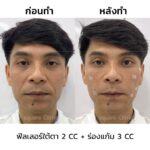 ฉีดฟิลเลอร์ คืออะไร ? เหมาะกับใคร ? รู้ข้อดี-ข้อเสียก่อนฉีดปรับรูปหน้า 