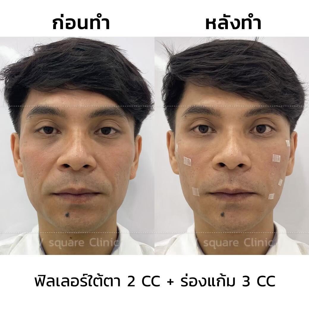 รีวิว ฉีดฟิลเลอร์ รีวิว ฉีดฟิลเลอร์
