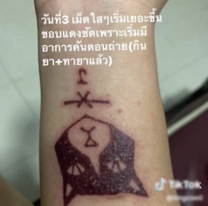 ภาพประกอบ แผลพุพอง