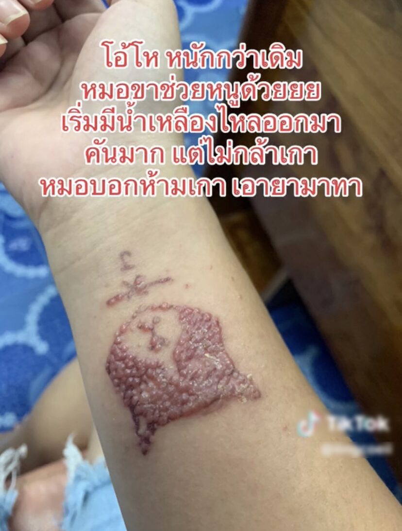 ภาพประกอบ แผลพุพอง