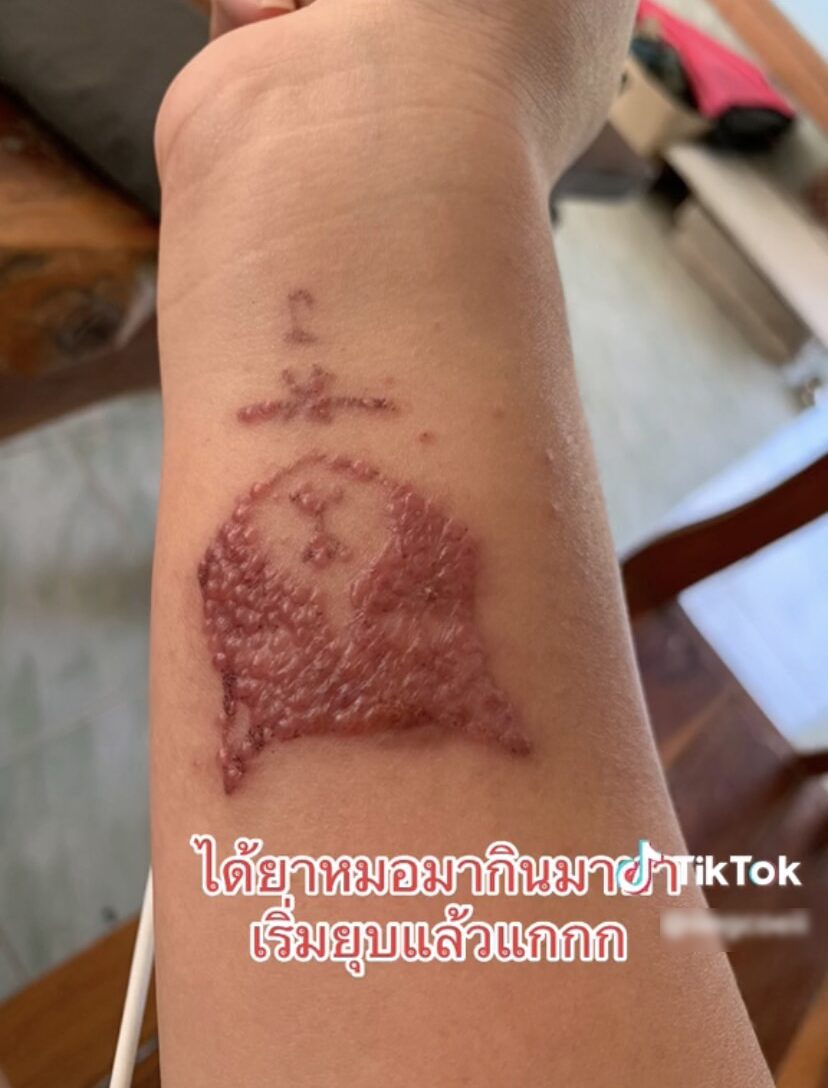 ภาพประกอบ แผลพุพอง