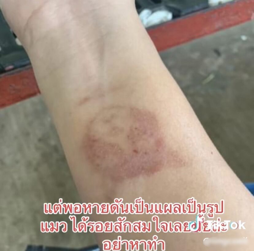 ภาพประกอบ รอยแผลเป็น