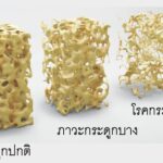 20 ตุลาคม วันกระดูกพรุนโลก 