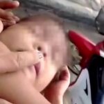 อุทาหรณ์เตือนภัย อย่าคาดสายตาหนูน้อย ลูกปัดเข้าจมูกติดหลอดลม โชคดีหมอช่วยทัน 