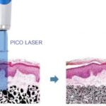 หลายสิ่งที่คนอาจจะยังไม่รู้เกี่ยวกับเครื่อง Pico Laser