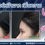 เทรนด์หน้าผากสวย เสริมโหงวเฮ้ง ที่กำลังมาแรงในปี 2024
