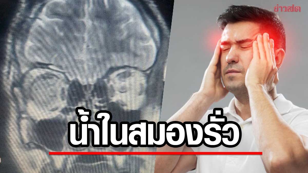 6-Year Headache Mystery Solved: Doctors Stunned to Discover Brain Fluid Leak Behind Syrian Man's Chronic Symptoms - News Directory 3
