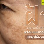 รวมคำถามยอดฮิตเกี่ยวกับฝ้า พร้อมทำความรู้จักทุกข้อมูลน่ารู้