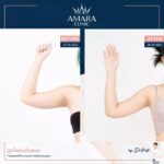 ดูดไขมันไม่แพงอย่างที่คิด รีวิวดูดไขมันราคาเบา ๆ ที่ Amara Clinic