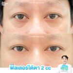 ฟิลเลอร์ใต้ตา เปลี่ยนหน้าโทรมให้สดใส โดยไม่ต้องผ่าตัด