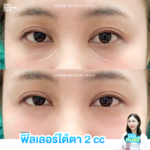 ฟิลเลอร์ใต้ตา เปลี่ยนหน้าโทรมให้สดใส โดยไม่ต้องผ่าตัด
