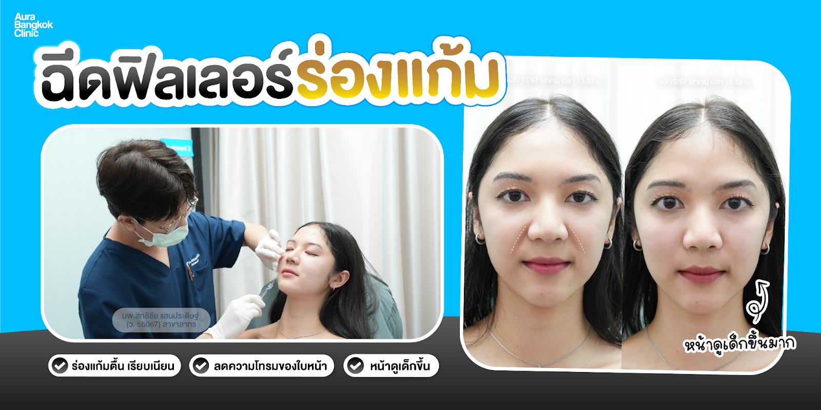 เติมร่องแก้ม