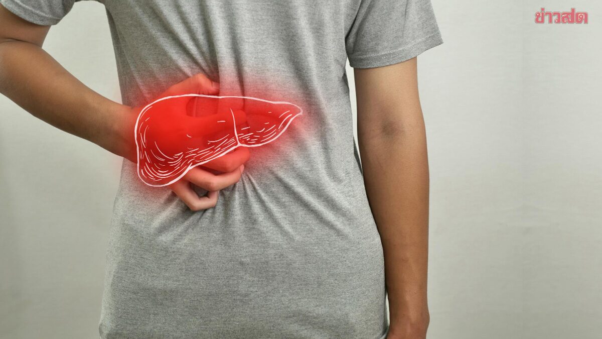 .แพทย์เผย พุงป่องจากบวมเบียร์ สัญญาณเตือน ไขมันพอกตับ แนะ 8 อาการพบบ่อย.