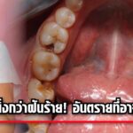 วิกฤติฟันผุ! คนไทยเกินครึ่งไม่รักษา ปล่อยไว้ อันตรายถึงชีวิต!