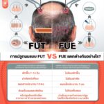 ปลูกผม คืออะไร มีเทคนิคอะไรบ้าง นอกจากผ่าตัดมีวิธีอื่นอีกไหม?