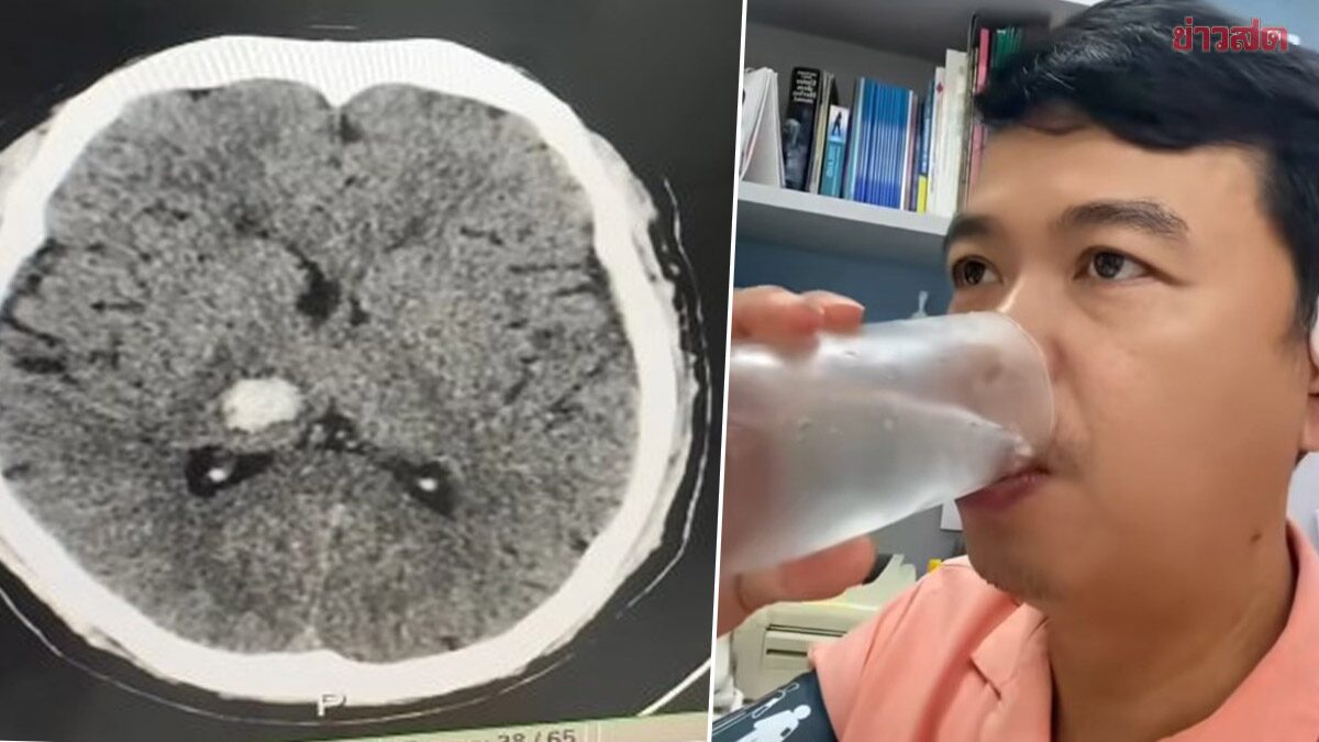 .หมอทดสอบให้ดู ดื่มน้ำเย็น ทำให้ความดันพุ่ง เส้นเลือดสมองแตกได้จริงไหม.