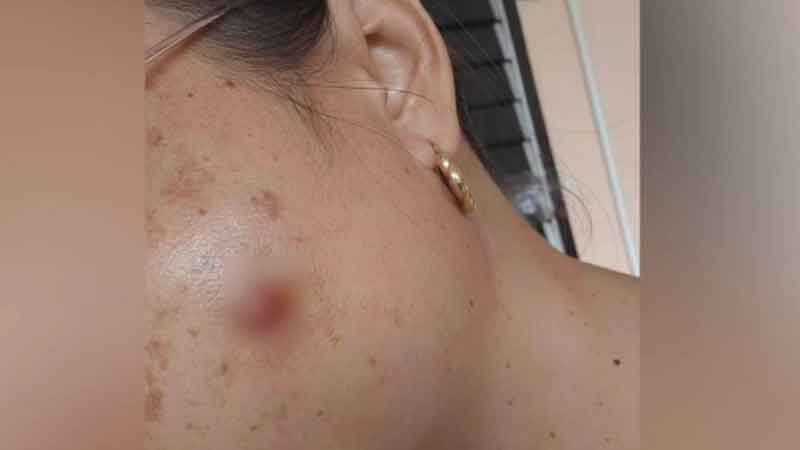 สุดสยอง สาวระยอง เจอพยาธิปูดออกใต้ตา ไชออกแก้ม หมอเตือนคนรักหมาแมว ต้องระวัง