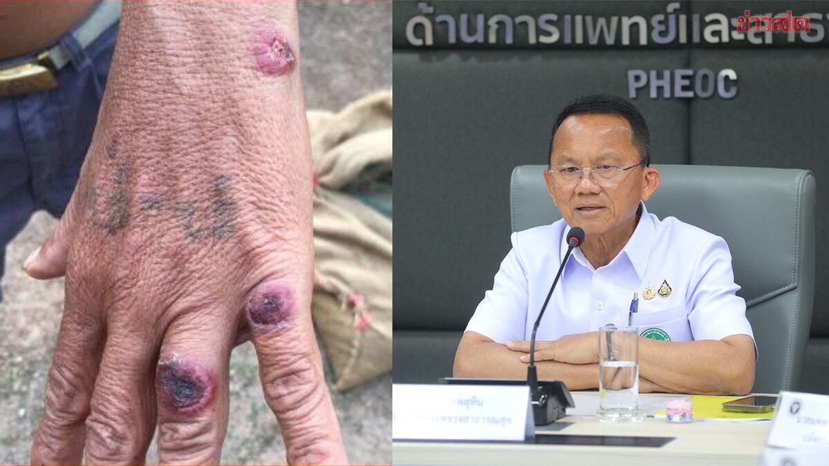 รมว.สธ.เผยไม่มีติดเชื้อ "แอนแทรกซ์"เพิ่ม ส่วน 636 รายรอดแล้วหลังพ้นระยะเฝ้าระวัง
