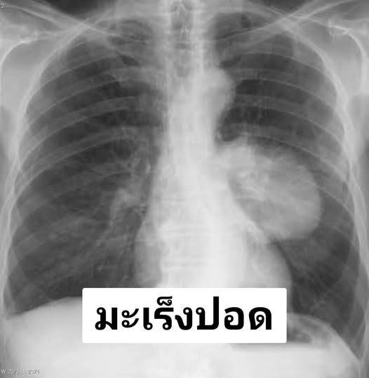 หมอเจด เปิด 10 เรื่องที่ควรรู้เกี่ยวกับ มะเร็งปอด เช็กเลยมีอะไรบ้าง ชี้ เป็นสาเหตุการตายอันดับต้น ๆ ของคนไทย เผย 5 สิ่งในบ้านที่ทำให้เสี่ยงเป็นได้