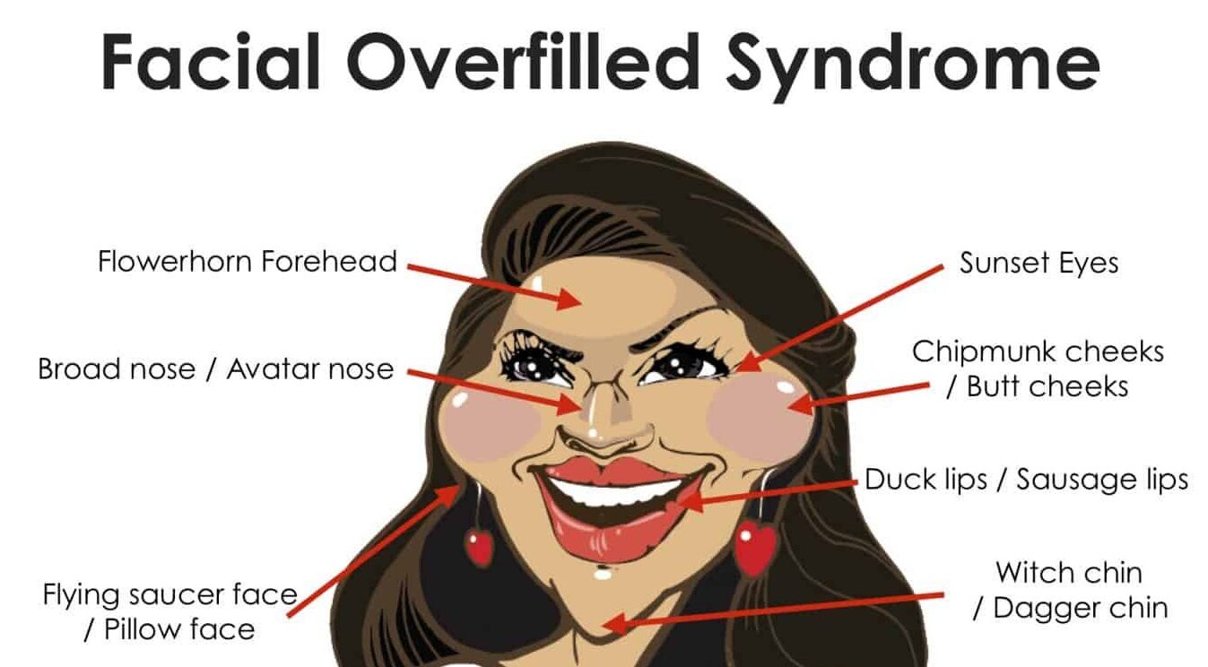 Facial-overfilled-syndrome