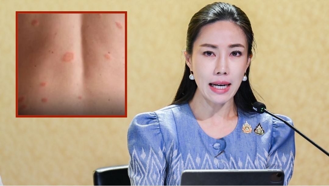 .เตือน 'โรคผื่นกุหลาบ' พบบ่อยช่วงฤดูฝน มักเกิดกับผู้หญิง ผู้ป่วยตั้งครรภ์ระวังเสี่ยงแท้งได้.