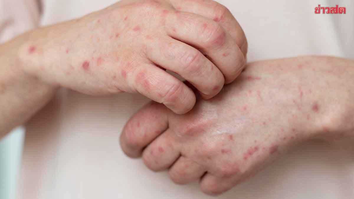 .HIV ระบาดหนัก ปี 68 ติดเชื้อพุ่งทะลุครึ่งล้าน ป่วยรายใหม่กว่า 1.3หมื่น.