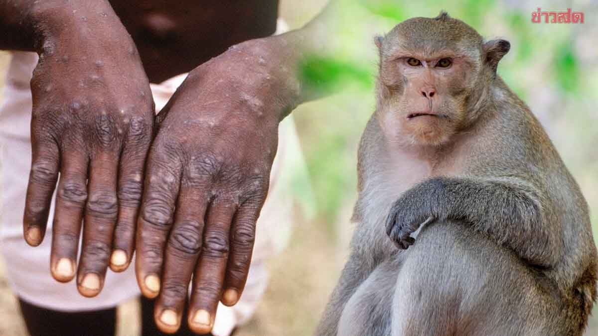 .ไทยพบผู้ป่วย ฝีดาษลิง สะสมแล้ว 40 ราย รัฐบาลสั่งเฝ้าระวังเข้ม แนะวิธีป้องกันตัวเอง.
