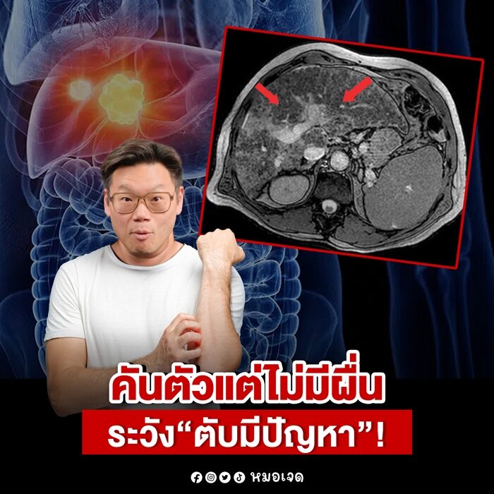หมอเจด เตือน "สัญญาณเงียบ" ใครเคย "คันทั้งตัว" แต่หาเท่าไรก็ไม่เจอผื่น เผย มีบางสิ่งในร่างกายเริ่มทำงานผิดปกติ ไม่ใช่ปัญหาผิว แนะวิธีดูแลสุขภาพ 