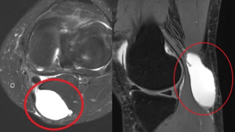 Baker’s cyst