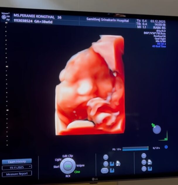 ภาพลูกชาย แมท ภีรนีย์ ใกล้คลอดมากๆแล้ว