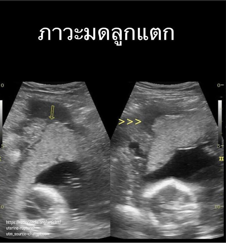 ภาวะมดลูกแตก