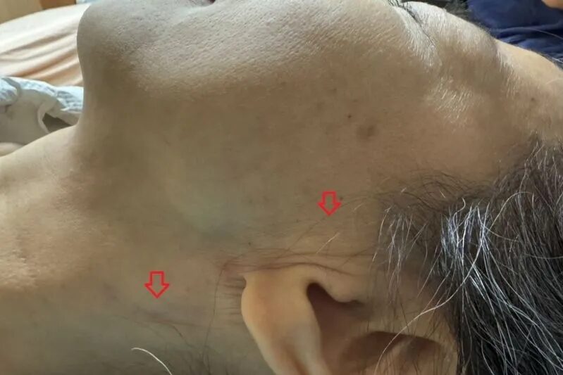 Salivary Gland Cancer)