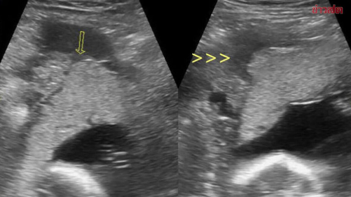 Uterine Rupture: 4 Critical Warning Signs You Should Never Ignore